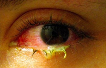 eye with conjunctivitis
